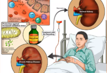 Rare Kidney Disease